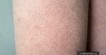 67dacbbe578956b2ab7c2887 queratosis pilaris 1 768x508 (1)