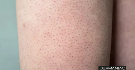 67dacbbe578956b2ab7c2887 queratosis pilaris 1 768x508 (1)