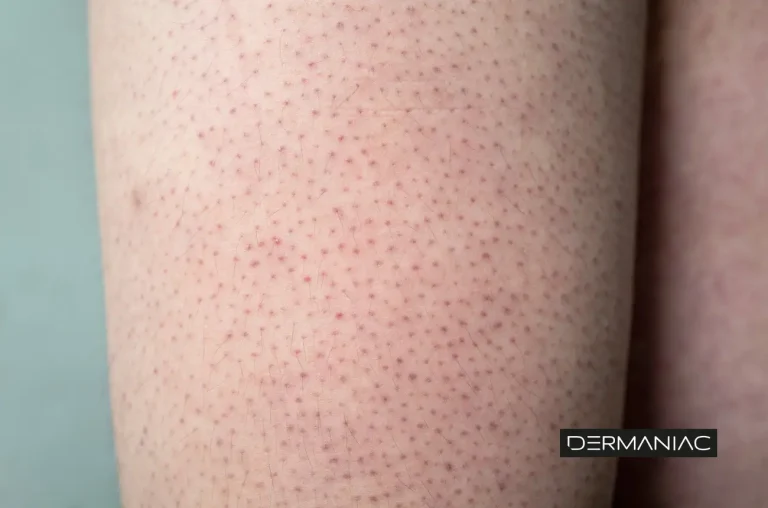 67dacbbe578956b2ab7c2887 queratosis pilaris 1 768x508