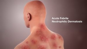 Medical Animation Acute Febrile Neutrophilic Dermatosis