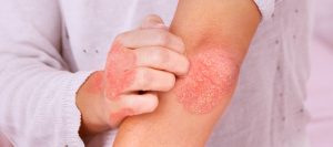 What are the best and best ingredeints for atopic dermatitis featured image reequil