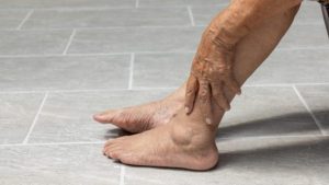 Foto pies hinchados 768x432