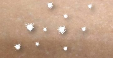 Hipomelanosis en gotas