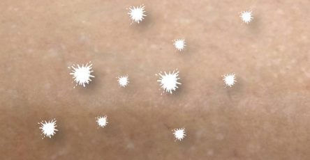 Hipomelanosis en gotas