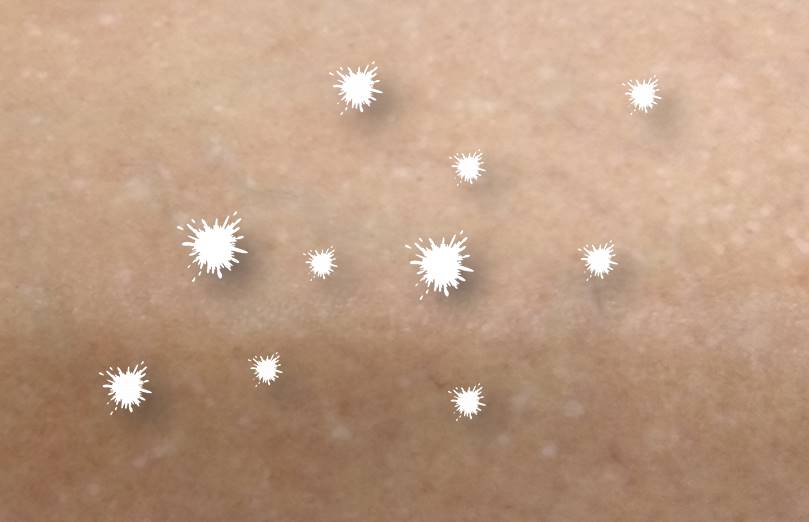 Hipomelanosis en gotas