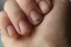Damaged damaged nail without manicure with dirt close up. Nail Health Care.